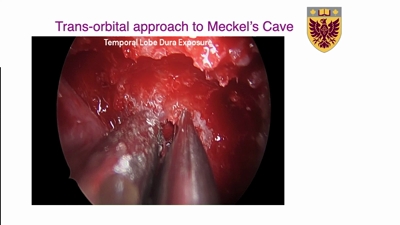 Thumb for william and kesh transorbital slides